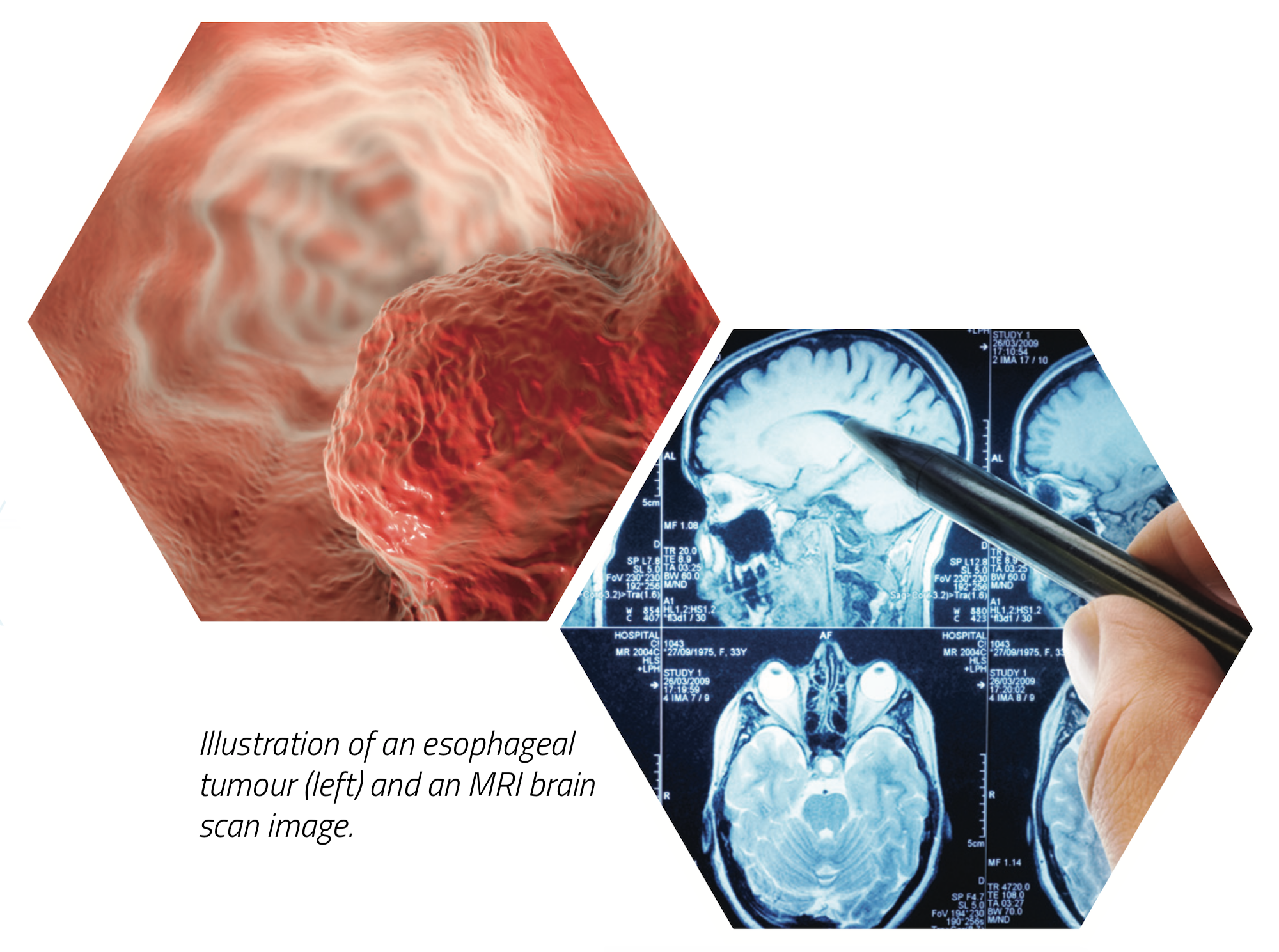 BIFROST esophageal tumour MRI brain scan